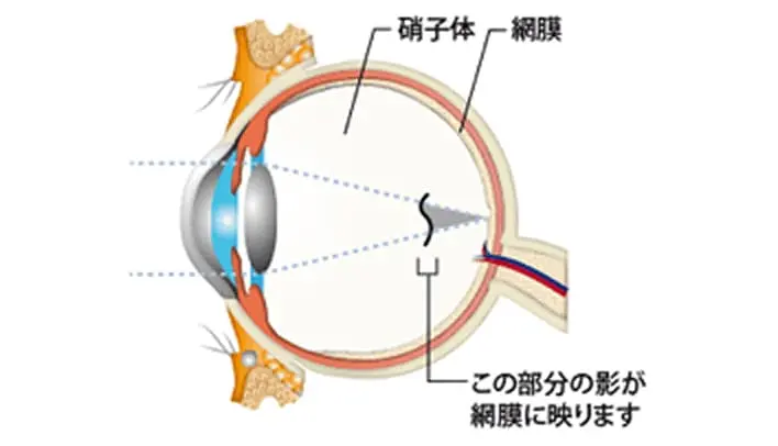飛蚊症のイメージ