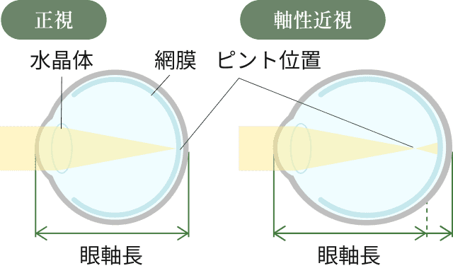近視の解説図