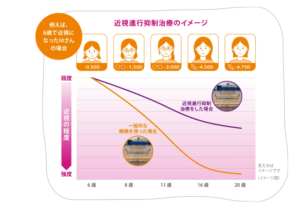 近視進行抑制治療のイメージ