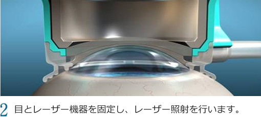 2 レンズとリングの位置を合わせます